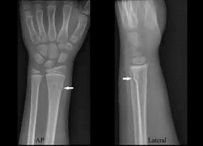 Buckle Fractures